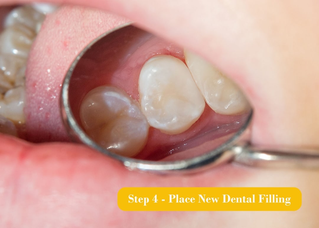 Composite Fillings Lighthouse Dental Centre Langley